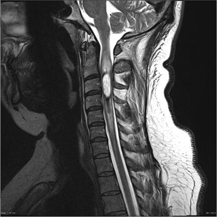 Spine Tumour